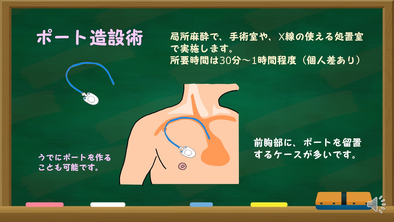 中心静脈カテーテル ポート造設ってなに？ | パンダ先生の病気の学校